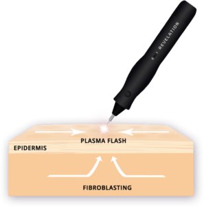 Plasma Pen Illustration | How It Works